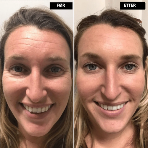 Clarivelle™ Det næste generations alternativ til retinol
