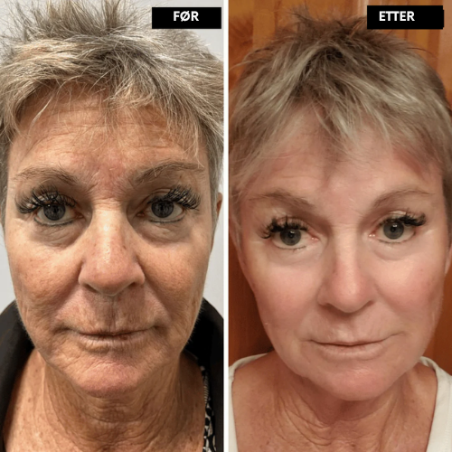 Clarivelle™ Det næste generations alternativ til retinol