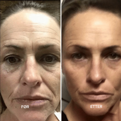 Clarivelle™ Det næste generations alternativ til retinol